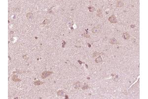 Paraformaldehyde-fixed, paraffin embedded human glioma, Antigen retrieval by boiling in sodium citrate buffer (pH6) for 15min, Block endogenous peroxidase by 3% hydrogen peroxide for 30 minutes, Blocking buffer (normal goat serum) at 37°C for 20min, Antibody incubation with ATP7A Polyclonal Antibody  at 1:400 overnight at 4°C, followed by a conjugated secondary and DAB staining.