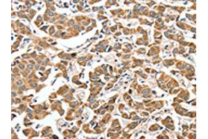The image on the left is immunohistochemistry of paraffin-embedded Human breast cancer tissue using ABIN7189774(ALDH9A1 Antibody) at dilution 1/50, on the right is treated with synthetic peptide. (ALDH9A1 anticorps)