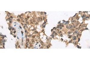 Immunohistochemistry of paraffin-embedded Human ovarian cancer tissue using ATRX Polyclonal Antibody at dilution of 1:50(x200) (ATRX anticorps)