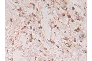 Detection of S100A11 in Human Breast cancer Tissue using Polyclonal Antibody to S100 Calcium Binding Protein A11 (S100A11)