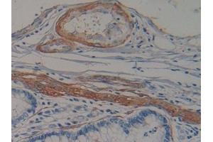 Detection of NT-ProANP in Human Colorectal cancer Tissue using Polyclonal Antibody to N-Terminal Pro-Atrial Natriuretic Peptide (NT-ProANP)