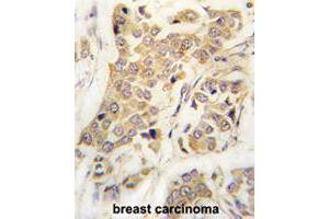 Formalin-fixed and paraffin-embedded human breast carcinomareacted with CDH8 polyclonal antibody , which was peroxidase-conjugated to the secondary antibody, followed by AEC staining. (Cadherin 8 anticorps  (N-Term))