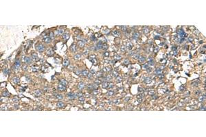 Immunohistochemistry of paraffin-embedded Human liver cancer tissue using RPS14 Polyclonal Antibody at dilution of 1:50(x200)