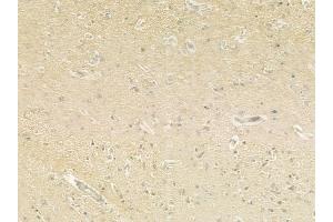 ABIN6260529 and ABIN6279318 at 1/100 staining human glioblastoma by IHC-P. (CCDC8 anticorps  (N-Term))