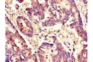 Immunohistochemistry of paraffin-embedded human colon cancer using ABIN7155909 at dilution of 1:100 (HCFC1 anticorps  (AA 201-428))