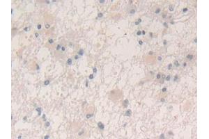 Detection of VEGFA in Human Glioma Tissue using Polyclonal Antibody to Vascular Endothelial Growth Factor A (VEGFA)