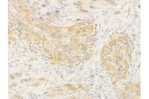 ABIN6260159 and ABIN6278363 at 1/100 staining human tongue carcinoma by IHC-P. (AVPR1A anticorps  (C-Term))