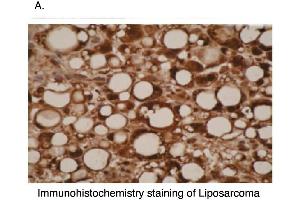 Immunohistochemical staining of liposarcoma cells using CYP26A1  antibody .
