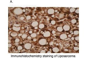 Immunohistochemical staining of liposarcoma cells using CYP26A1  antibody . (CYP26A1 anticorps  (C-Term))