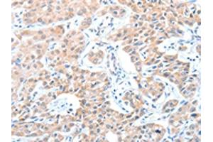 The image on the left is immunohistochemistry of paraffin-embedded Human lung cancer tissue using ABIN7128233(ADAM21 Antibody) at dilution 1/15, on the right is treated with fusion protein. (ADAM21 anticorps)