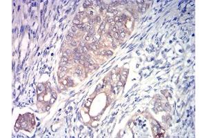 Immunohistochemical analysis of paraffin-embedded cervical cancer tissues using ACSS1 mouse mAb with DAB staining.