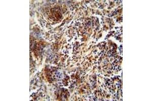 ZNF30 antibody (N-term) immunohistochemistry analysis in formalin fixed and paraffin embedded human lung carcinoma followed by peroxidase conjugation of the secondary antibody and DAB staining. (ZFP30 anticorps  (N-Term))