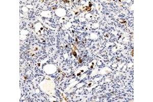Immunohistochemistry of paraffin embedded human stomcah cancer using c-caspase3 (ABIN7073336) at dilution of 1:600 (200x lens)