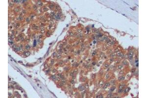 Detection of FN in Human Liver cancer Tissue using Polyclonal Antibody to Fibronectin (FN)