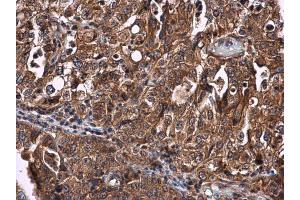 IHC-P Image CYP27A1 antibody detects CYP27A1 protein at cytoplasm in human endometrial carcinoma by immunohistochemical analysis.