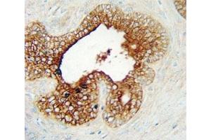 LAG3 antibody immunohistochemistry analysis in formalin fixed and paraffin embedded human prostate carcinoma.