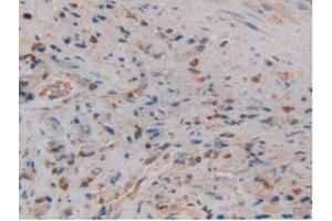 IHC-P analysis of Human Prostate Gland Cancer Tissue, with DAB staining. (Lipocalin 2 anticorps  (AA 21-198))