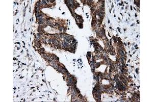 Immunohistochemical staining of paraffin-embedded Adenocarcinoma of colon tissue using anti-FKBP1A mouse monoclonal antibody. (FKBP1A anticorps)