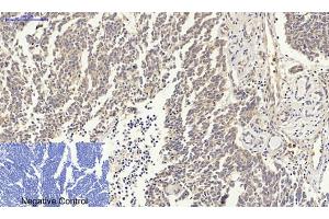Immunohistochemical analysis of paraffin-embedded human lung cancer tissue. (p53 anticorps)