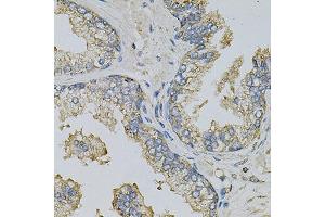 Immunohistochemistry of paraffin-embedded human prostate using PSAT1 Antibody (ABIN6293473) at dilution of 1:100 (40x lens). (PSAT1 anticorps)