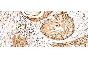 Immunohistochemistry of paraffin-embedded Human esophagus cancer tissue using ELF3 Polyclonal Antibody at dilution of 1:95(x200) (ELF3 anticorps)