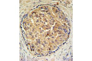 SRD5A3 Antibody IHC analysis in formalin fixed and paraffin embedded human prostate carcinoma followed by peroxidase conjugation of the secondary antibody and DAB staining. (SRD5A3 anticorps  (C-Term))