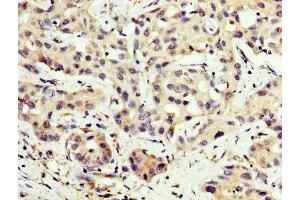 IHC image of ABIN7146841 diluted at 1:200 and staining in paraffin-embedded human liver cancer performed on a Leica BondTM system. (CPT2 anticorps  (AA 388-551))