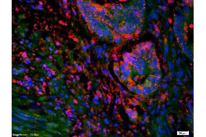 Formalin-fixed and paraffin-embedded human colon labeled with Anti-SOAT2/ACAT2 Polyclonal Antibody, Unconjugated (ABIN708476) 1:200, overnight at 4°C, The secondary antibody was Goat Anti-Rabbit IgG, Cy3 conjugated used at 1:200 dilution for 40 minutes at 37°C.