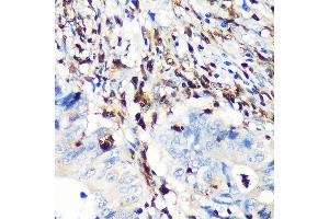 Immunohistochemistry of paraffin-embedded human colon carcinoma using FSP1/S100 Rabbit mAb (ABIN7270125) at dilution of 1:100 (40x lens). (s100a4 anticorps)