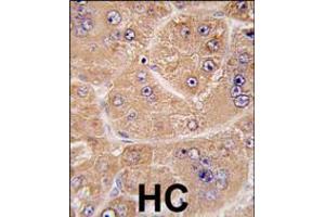 Formalin-fixed and paraffin-embedded human hepatocarcinoma tissue reacted with FUCA2 antibody , which was peroxidase-conjugated to the secondary antibody, followed by DAB staining. (FUCA2 anticorps  (N-Term))