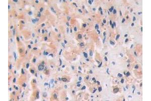 DAB staining on IHC-P; Samples: Human Prostate cancer Tissue (PRSS8 anticorps  (AA 33-218))