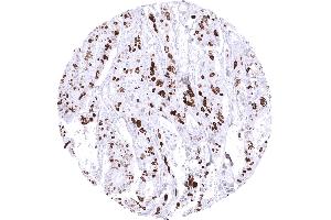 Colon Colorectal adenocarcinoma with TOPO2A immunostaining in _50 of tumor cells (Recombinant Topoisomerase II alpha anticorps  (AA 1352-1493))