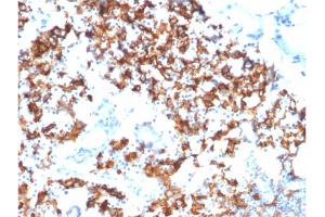 Formalin-fixed, paraffin-embedded human Gastric Carcinoma stained with IL3RA/CD123 Mouse Monoclonal Antibody (IL3RA/1531).