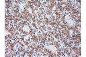 Immunohistochemical staining of paraffin-embedded Carcinoma of liver tissue using anti-SERPINA1mouse monoclonal antibody. (SERPINA1 anticorps)