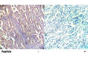 Immunohistochemical analysis of paraffin-embedded human lung carcinoma tissue using PRKAB1 polyclonal antibody . (PRKAB1 anticorps  (Ser182))
