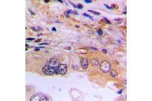 Immunohistochemical analysis of EEF2K staining in human lung cancer formalin fixed paraffin embedded tissue section. (EEF2K anticorps  (Center))
