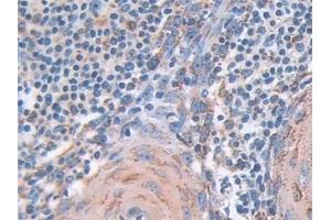 Detection of SOD2 in Human Skin cancer Tissue using Polyclonal Antibody to Superoxide Dismutase 2, Mitochondrial (SOD2) (SOD2 anticorps  (AA 25-222))