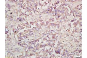 Formalin-fixed and paraffin embedded human lung carcinoma labeled with Rabbit Anti-V-ATPase A1 Polyclonal Antibody, Unconjugated (ABIN1387667) at 1:200 followed by conjugation to the secondary antibody and DAB staining (V-ATPase 116 kDa Isoform a1 (AA 41-140) anticorps)