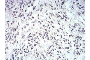 Immunohistochemical analysis of paraffin-embedded esophageal cancer tissues using IL28A mouse mAb with DAB staining.