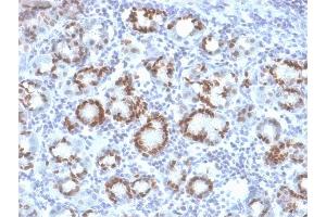 Formalin-fixed, paraffin-embedded human Gastric Carcinoma stained with SOX9 Mouse Monoclonal Antibody (SOX9/2387). (SOX9 anticorps  (AA 393-508))