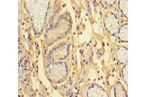 Immunohistochemistry of paraffin-embedded human gastric cancer using ABIN7163422 at dilution of 1:100 (ANKRD33 anticorps  (AA 1-272))