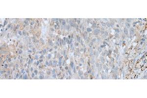 Immunohistochemistry of paraffin-embedded Human lung cancer tissue using VWA2 Polyclonal Antibody at dilution of 1:45(x200) (VWA2 anticorps)