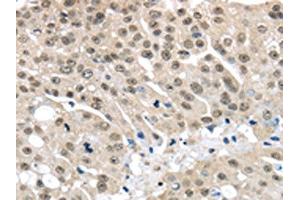 The image on the left is immunohistochemistry of paraffin-embedded Human breast cancer tissue using ABIN7130212(MED15 Antibody) at dilution 1/30, on the right is treated with fusion protein. (MED15 anticorps)