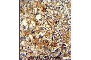Formalin-fixed and paraffin-embedded human breast carcinoma with ACTN1 Antibody (N-term), which was peroxidase-conjugated to the secondary antibody, followed by DAB staining. (ACTN1 anticorps  (N-Term))