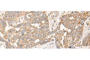 Immunohistochemistry of paraffin-embedded Human liver cancer tissue using CPNE3 Polyclonal Antibody at dilution of 1:40(x200) (Copine III anticorps)