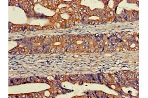 Immunohistochemistry of paraffin-embedded human colon cancer using ABIN7152131 at dilution of 1:100 (EIF2S1 anticorps  (AA 276-315))