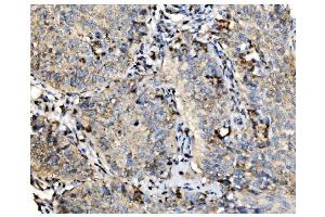 IHC analysis of GOLPH2/GOLM1 using anti-GOLPH2/GOLM1 antibody (ABIN7601505).
