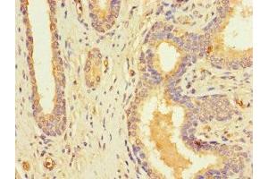 Immunohistochemistry of paraffin-embedded human prostate cancer using ABIN7168091 at dilution of 1:100 (Riboflavin Kinase anticorps  (AA 1-154))