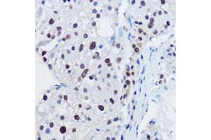 Immunohistochemistry of paraffin-embedded human liver cancer using  Rabbit pAb (ABIN7265580) at dilution of 1:150 (40x lens). (ANAPC11 anticorps  (AA 1-84))