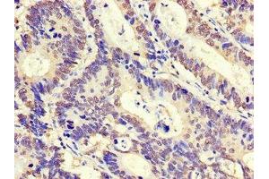 Immunohistochemistry of paraffin-embedded human colon cancer using ABIN7176555 at dilution of 1:100 (ZNF844 anticorps  (AA 1-300))